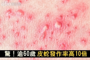 驚!逾60歲皮蛇發作率高10倍