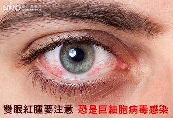 雙眼紅腫要注意 恐是巨細胞病毒感染