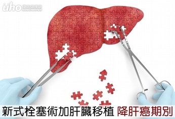 新式栓塞術加肝臟移植 降肝癌期別