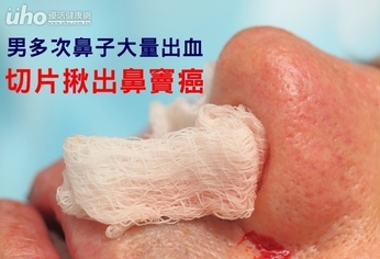 男多次鼻子大量出血 切片揪出鼻竇癌