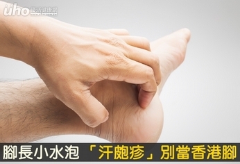 腳長小水泡 「汗皰疹」別當香港腳