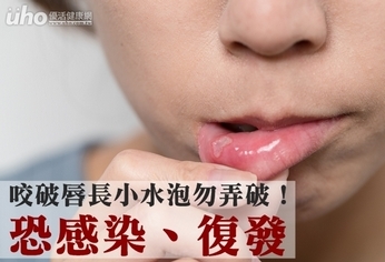 咬破唇長小水泡勿弄破!恐感染、復發