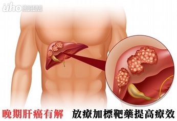 晚期肝癌有解 放療加標靶藥提高療效