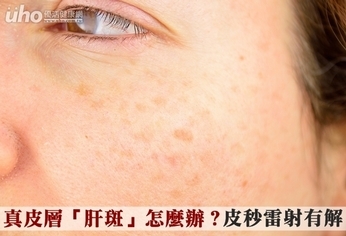 真皮層「肝斑」怎麼辦?皮秒雷射有解
