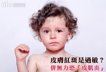 皮膚紅斑是過敏?併無力恐「皮肌炎」