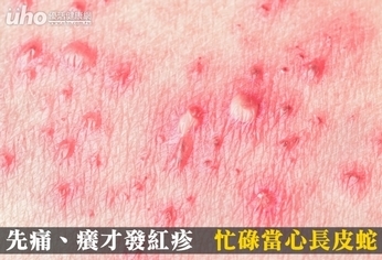 先痛、癢才發紅疹 忙碌當心長皮蛇