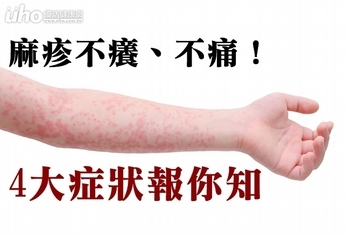 麻疹不癢、不痛!4大症狀報你知