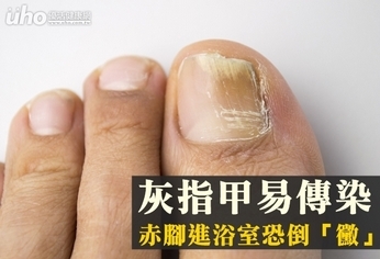 灰指甲易傳染 赤腳進浴室恐倒「黴」
