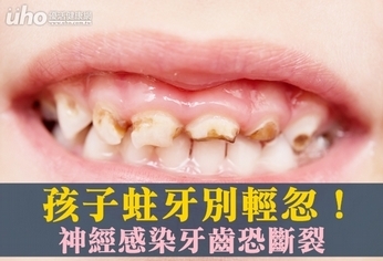 孩子蛀牙別輕忽!神經感染牙齒恐斷裂