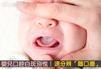 嬰兒口腔白斑別慌!速分辨「鵝口瘡」