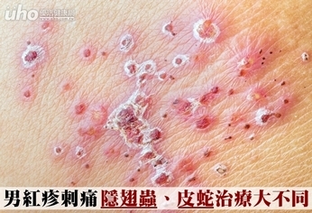 男紅疹刺痛 隱翅蟲、皮蛇治療大不同