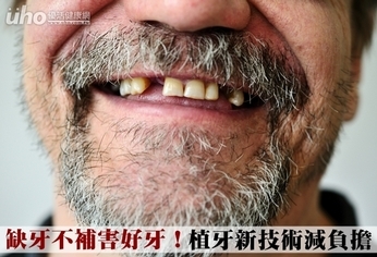 缺牙不補害好牙!植牙新技術減負擔