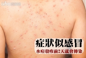 症狀似感冒 水痘發疹前2天就會傳染