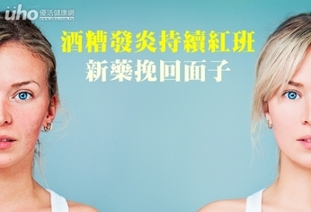 酒糟發炎持續紅班 新藥挽回面子