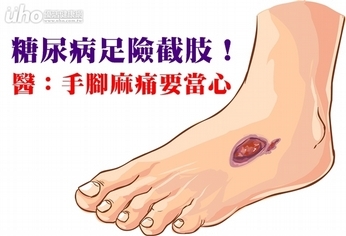 糖尿病足險截肢!醫:手腳麻痛要當心