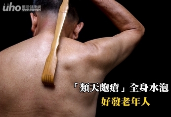 「類天皰瘡」全身水泡 好發老年人