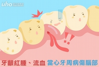 牙齦紅腫、流血 當心牙周病傷腦部