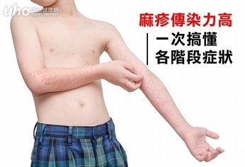 麻疹傳染力高 一次搞懂各階段症狀