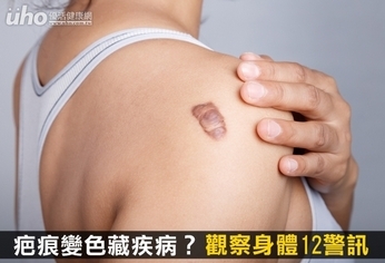 疤痕變色藏疾病?觀察身體12警訊