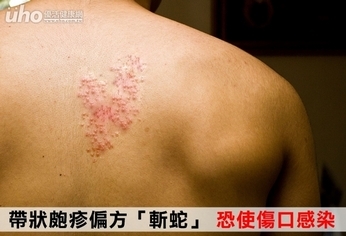 帶狀皰疹「斬蛇」偏方 恐使傷口感染