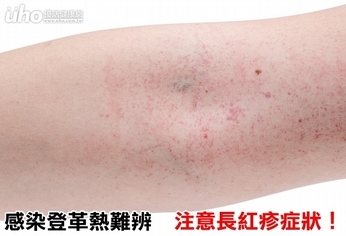 感染登革熱難辨 注意長紅疹症狀!