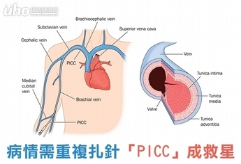 病情需重複扎針 「PICC」成救星