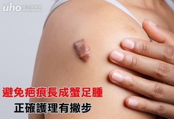 避免疤痕長成蟹足腫 正確護理有撇步
