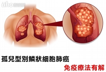 孤兒型別鱗狀細胞肺癌 免疫療法有解