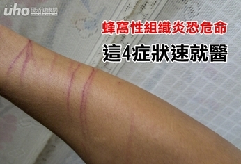 蜂窩性組織炎恐危命 這4症狀速就醫