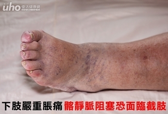 下肢嚴重脹痛 髂靜脈阻塞恐面臨截肢