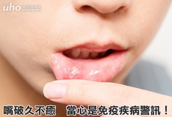 嘴破久不癒 當心是免疫疾病警訊!