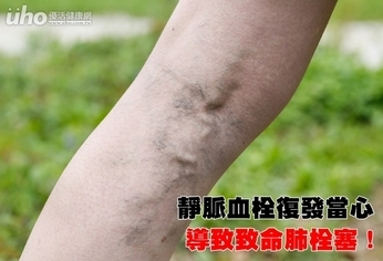 靜脈血栓復發 當心導致致命肺栓塞!