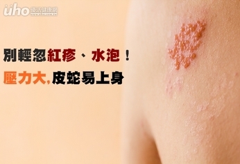 別輕忽紅疹、水泡!壓力大皮蛇易上身