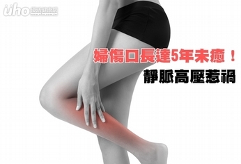 婦傷口長達5年未癒!靜脈高壓惹禍