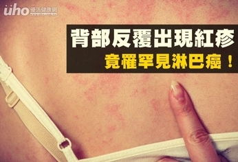 背部反覆出現紅疹 竟罹罕見淋巴癌!
