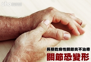 長期乾癬性關節炎不治療 關節恐變形