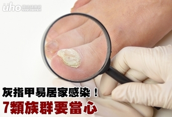 灰指甲易居家感染!7類族群要當心