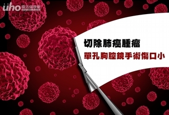 切除肺癌腫瘤 單孔胸腔鏡手術傷口小