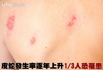 皮蛇發生率逐年上升 1/3人恐罹患