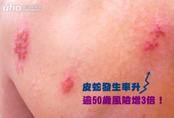 皮蛇發生率升 逾50歲風險增3倍!