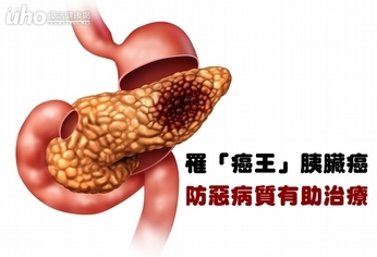 罹「癌王」胰臟癌 防惡病質有助治療