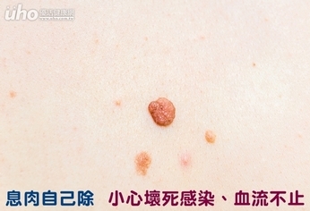 息肉自己除 小心壞死感染、血流不止