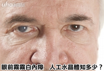眼前霧霧白內障 人工水晶體知多少?