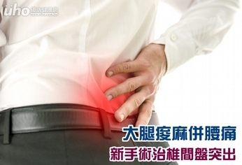 大腿痠麻併腰痛 新手術治椎間盤突出