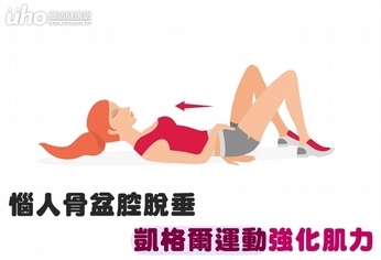 惱人骨盆腔脫垂 凱格爾運動強化肌力