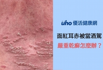面紅耳赤被當酒駕 嚴重乾癬怎麼辦?