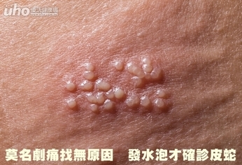 莫名劇痛找無原因 發水泡才確診皮蛇