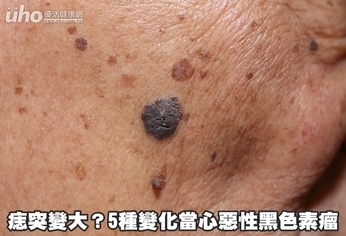 痣突變大?5種變化當心惡性黑色素瘤