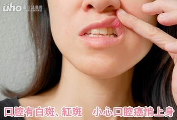 口腔有白斑、紅斑 小心口腔癌悄上身