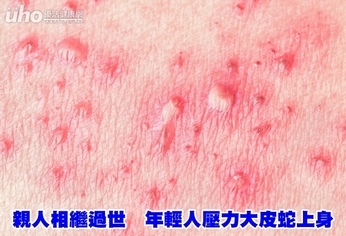 親人相繼過世 年輕人壓力大皮蛇上身